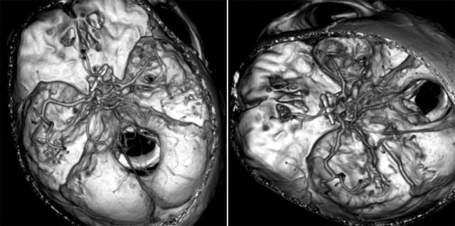 平時(shí)不注意甲醛超標(biāo)，50歲女子劇烈頭痛、惡心干嘔，一查已是癌癥晚期！