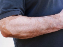 甲醛超標(biāo)和白癜風(fēng)有關(guān)系嗎？裝修污染對(duì)人體影響極大！